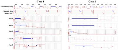 Temporal Course of Cerebral Autoregulation in Patients With Narcolepsy Type 1: Two Case Reports